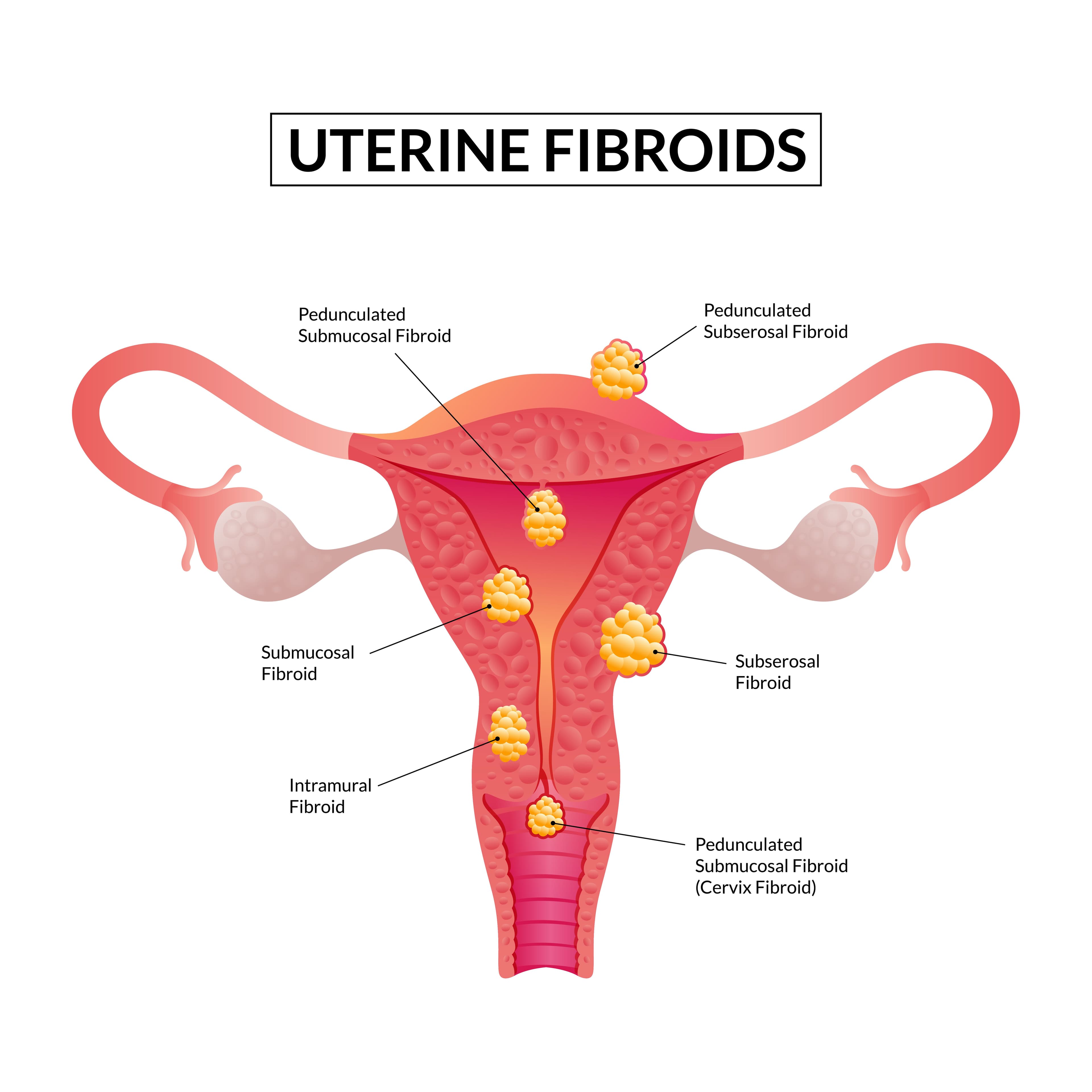 Managing Fibroids Naturally: Diet and Exercise Tips That Help